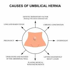 Image result for stomach hernia symptoms