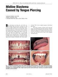 Pdf Midline Diastema Caused By Tongue Piercing