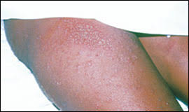 It is slightly warm but not painful or itchy. Common Skin Conditions During Pregnancy American Family Physician