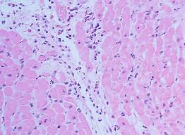 Myocarditis can be classified in a number of different ways. Classification Histopathology Immunohistology And Molecular Diagnosis Of Myocarditis Springerlink