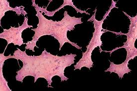 It is referred to as inflammatory due to its frequent presentation with symptoms resembling a skin inflammation, such as erysipelas. Inflammatory Breast Cancer Fact Sheet Oncology Nurse Advisor