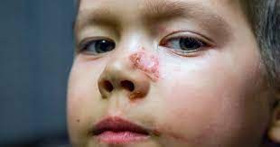 Borkenflechte Impetigo Contagiosa Ursache Symptom Behandlung