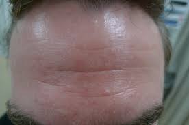 Sebaceous hyperplasia occurs when the sebaceous glands become enlarged with trapped sebum. Acd A Z Of Skin Sebaceous Hyperplasia