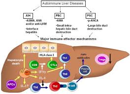 How might treatment for autoimmune hepatitis affect the management of my other medical conditions? Role Of Nkt Cells In Autoimmune Liver Disease Sciencedirect