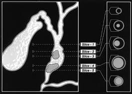 Image result for Choledocholithiasis