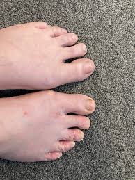 Home remedy for removing foot fungus