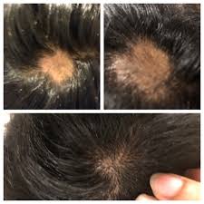 To find the cause of hair loss, a dermatologist may do blood tests and examine a sample of tissue from the scalp under a microscope. This Group Gave Me Hope Dermarolling Worked After Dermatologist Said It Was Just Natural Hair Loss And Would Grow Back Wasn T Growing Back After Months Of Waiting So I Took Matters Into