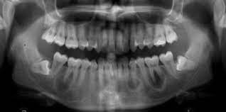Check spelling or type a new query. Florid Cemento Osseous Dysplasia In A Young Indian Woman A Case Report British Dental Journal