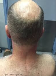 Its symptoms are generally a skin rash and worsening muscle weakness over time. Idiopathic Inflammatory Myopathies Clinical Approach And Management Abstract Europe Pmc