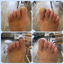 Image result for mykoza nehtů