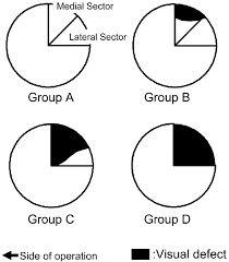 Image result for Visual Field Deficit