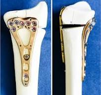 Volar versus combined dorsal and volar plate fixation of ...
