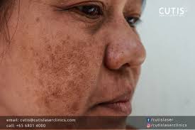 Image result for Melasma