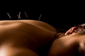 Acupuncture for back pain relief