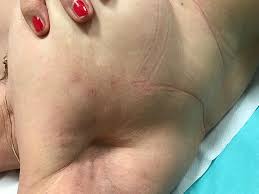 Image result for zoster under breasts