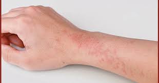 افضل دكتور جلدية بالرياض للاكزيما عن تجربة شخصية