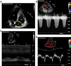 Visit the myocarditis foundation online to learn more. Echocardiographic Features Of Patients With Covid 19 Infection A Cross Sectional Study Springerlink