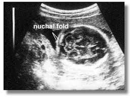 Getting the dates correct is crucial to the safety of pregnancy and can prevent unnecessary induction of labour. Other Fetal Measurements