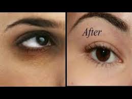 I Use Turmeric To Clear My Dark Under Eye Circle In 3 Days Youtube Dark Under Eye Undereye Dark Circles Around Eyes