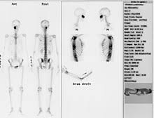 Von nora terkawi, anne schulze, eric franz gkp 18/2 tb8 herrn mario zado. Szintigrafie Wikipedia