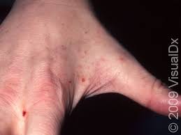 Image result for scabies human bites