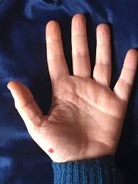 Ridurre il mal di gola con la digitopressione (con video) - Laura Vanni  Medicina Cinese