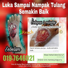 For more information and source, see on this link : Cara Merawat Luka Pesakit Diabetes Teruk Nampak Tulang Hampir Potong Kaki