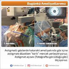 Astigmatli Gozlerde Katarakt Ameliyatinda Goz Icine Astigmati Duzelten Torik Mercek Yerlestiriyoruz Astigmat Acisini Fotografta Goruldug Fotograf Ordu Ikiz