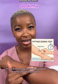 Image result for Edema Exam