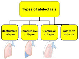 Atelectasis