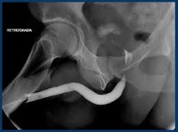 Image result for Retrograde Urethrogram