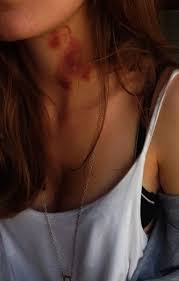 Pin On Love Bites