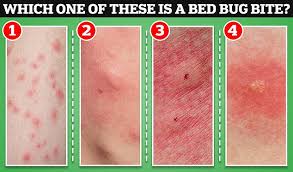 Image result for bedbug bites look like