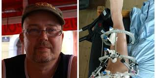 Ken er sengeliggende med ben gennemboret af skruer: Jobcenter vil have ham  til samtale