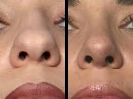 Broad Nasal Tip Rhinoplasty History Of The Procedure Problem Epidemiology Rhinoplasty Rhinoplasty Nose Jobs Rhinoplasty Surgery