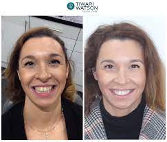 Teeth Whitening Glasgow Tiwari Watson Dental Care