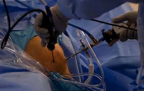 How well does surgery work? Meniscus Surgery How Effective Is It A Review Stem Cell Blog