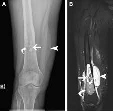 Image result for Chondrosarcoma
