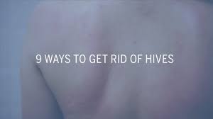 Hives can cause your skin to get very red and hot. 9 Ways To Get Rid Of Hives Health Youtube