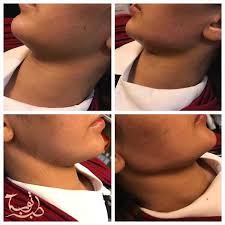 .تطويل الذقن، وأضاف أن أصل هذه الموضة يرجع إلى أوروبا وأمريكا حينما قرر بعض الشباب تطويل ذقنهم وتوفير ثمن الحلاقة والتبرع بها لمرضى السرطان، وأضاف أن موضة تطويل. ØªÙƒÙ„ÙØ© Ø¹Ù…Ù„ÙŠØ© Ø§Ù„ØªØ¬Ù…ÙŠÙ„ Ø§Ù„Ø°Ù‚Ù† ÙÙŠ Ø§ÙŠØ±Ø§Ù† 2020 Ù†ØªØ§Ø¦Ø¬ Ø¹Ù…Ù„ÙŠØ© Ø³Ø­Ø¨ Ø§Ù„Ø°Ù‚Ù† Ø¹Ù…Ù„ÙŠØ© Ø§Ù„ÙÙƒ Ø§Ù„Ø³ÙÙ„ÙŠ ÙˆØ§Ù„Ø¹Ù„ÙˆÙŠ Ø§ÙŠØ±Ø§Ù†