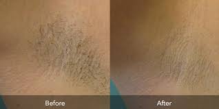 Laser hair removal method removes dark, coarse unwanted hair from various parts of the body, and there is no more risk of ingrown hair, razor cuts hence it is a good idea to take cold showers after the laser hair removal treatment. Laser Hair Removal Flawless Body Skin Body Laser Aesthetics