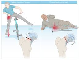The dashboard will allow qualified users to perform detailed queries of their institutional data and. Hip Fractures Amboss