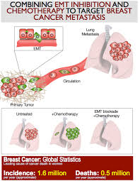Secondary breast cancer may not spread to all or any of these places. Breast Cancer Metastasis Study Suggests New Therapy Cornell Chronicle