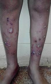 Image result for Anhidrosis