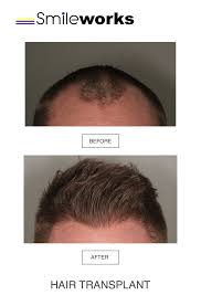 At the low end, it'll be $3,000 for a hair transplant in denver. Fue Hair Transplant Liverpool Top Surgeons From 99 Pm