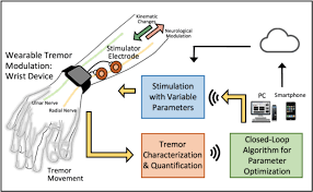 The resting tremor of parkinson's disease can also occur in the jaw, chin, mouth, or tongue. A Wearable System For Attenuating Essential Tremor Based On Peripheral Nerve Stimulation Embs