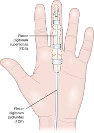 The fds to the middle finger is tested by holding the other 3 fingers in full extension, thereby immobilizing the profundis fdp (shown in black), and asking the patient to bend the finger. note that the fdp flexes the dip specifically, but will also flex the pip indirectly as well. Two Stage Reconstruction With The Modified Paneva Holevich Technique Plastic Surgery Key