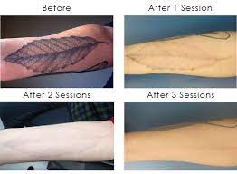The cost of having a tattoo removed (and the number of treatments necessary) is dependent on many different variables including the size of the tattoo, ink type, colors used, tattoo age, the patient's skin color and type of laser used for treatment. Remove Henna Tattoo Faster Oktober 2017
