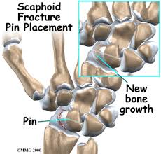 Image result for Scaphoid Bone