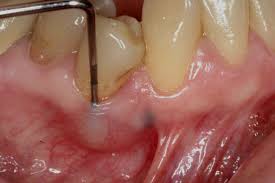 Image result for Periodontal Abscess